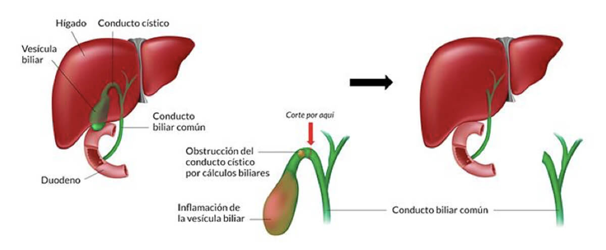 Laparoscópica la biliar • Cirugía Madrid