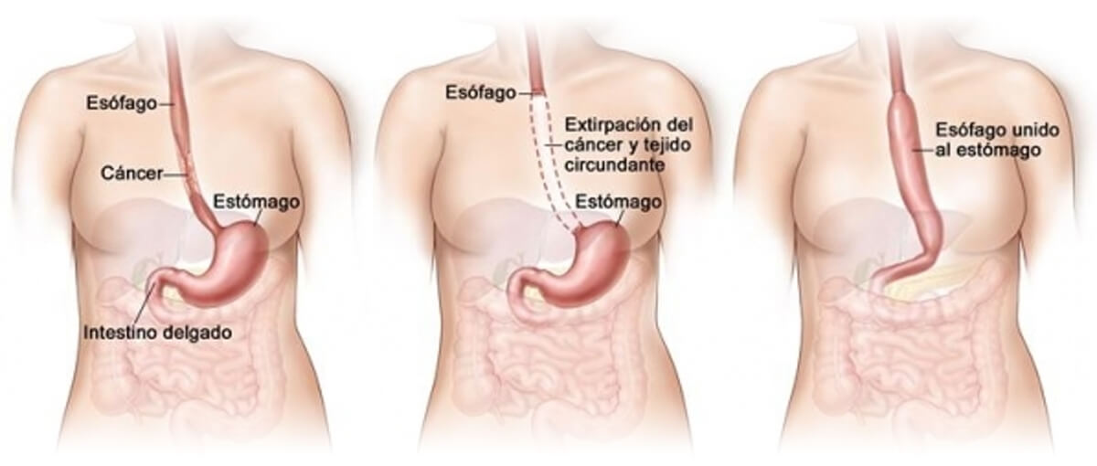 Cirugía Laparoscópica del cáncer de esófago img1