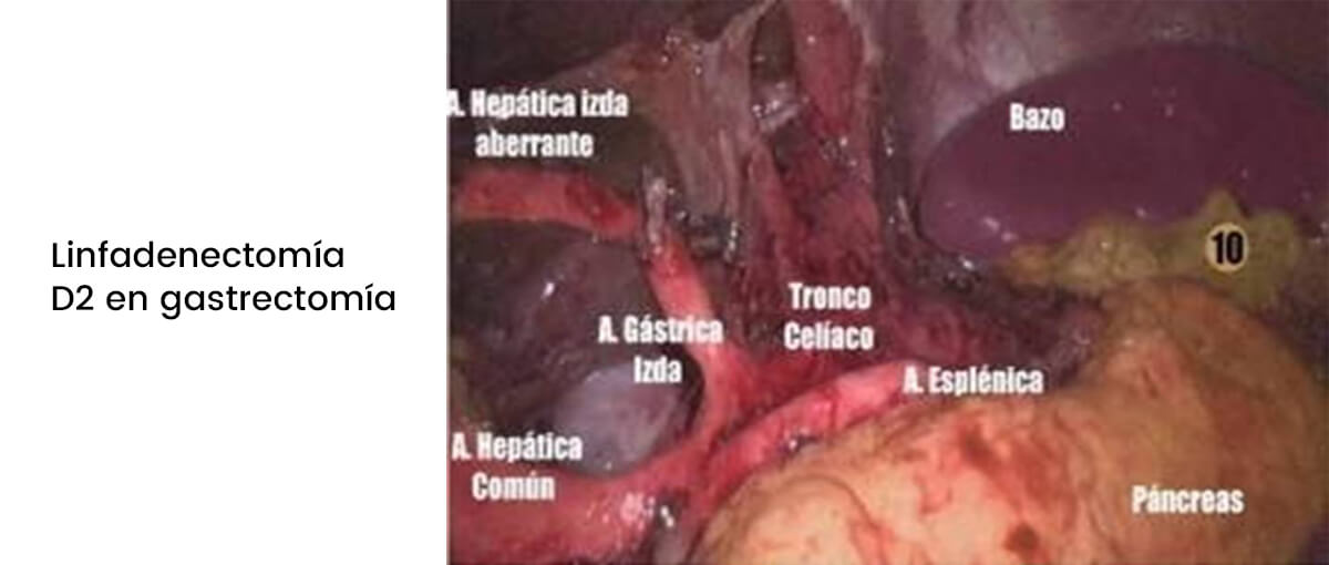 Cirugía Laparoscópica del cáncer de estómago img2