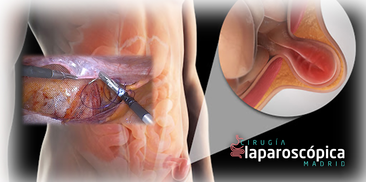Cirugía mínimamente invasiva de la pared abdominal: Hernias, Eventraciones y Diástasis de rectos Cirugía Laparoscópica Madrid